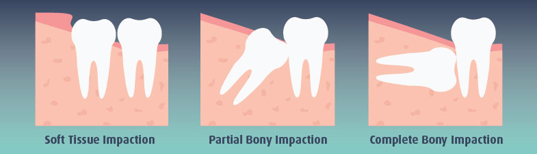 Wisdom Teeth | Orta Oral Surgery - Tampa FL